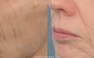 Fraxel laser to reduce wrinkles around the nose and mouth