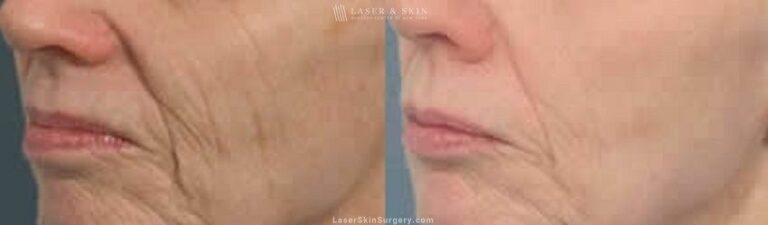 Fraxel laser to reduce wrinkles around the nose and mouth