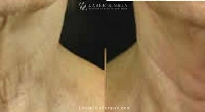 Fraxel laser used to rejuvenate skin on neck and minimize the appearance of lines and creases