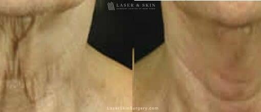 Fraxel laser used to rejuvenate skin on neck and minimize the appearance of lines and creases