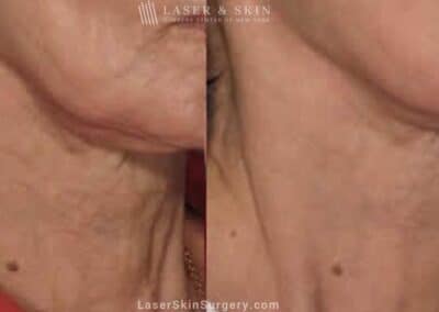 Fraxel laser used to rejuvenate the skin on the neck