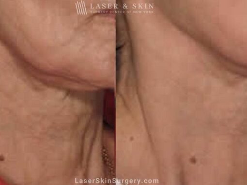 Fraxel laser used to rejuvenate the skin on the neck