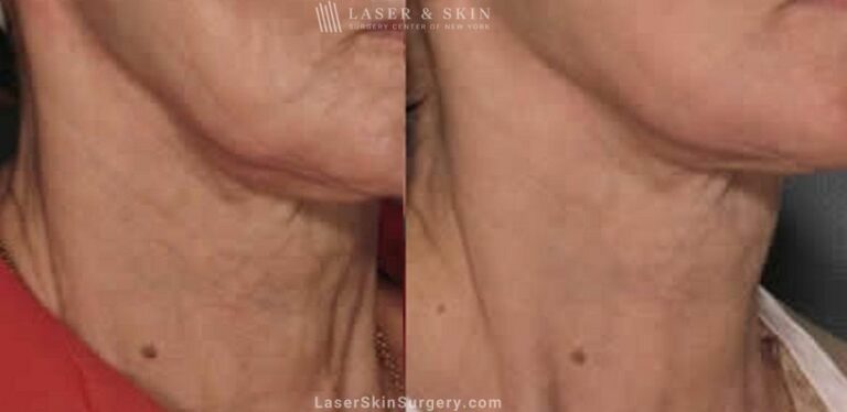 Fraxel laser used to rejuvenate the skin on the neck