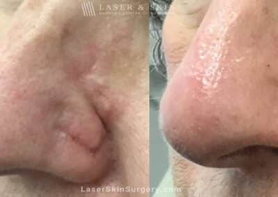Fraxel Laser to Treat Nose Scar