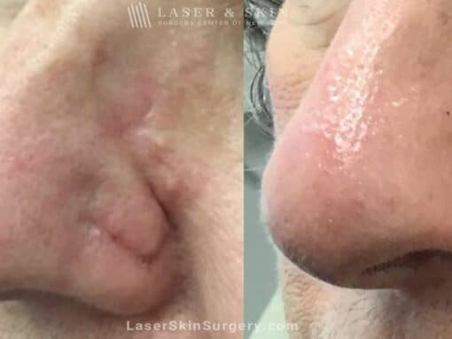 Fraxel Laser to Treat Nose Scar