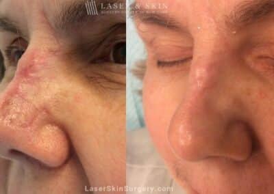 Fraxel Laser to Treat Nose Scar