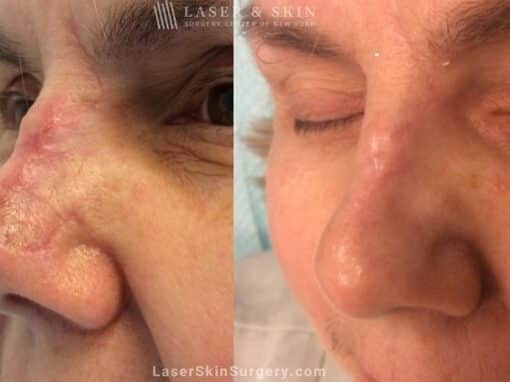 Fraxel Laser to Treat Nose Scar