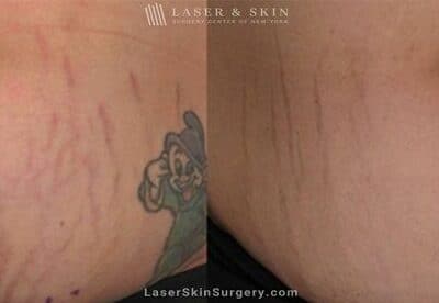 Fraxel laser used to reduce the appearance of stretch marks on the abdomen