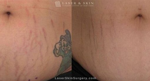 Fraxel laser used to reduce the appearance of stretch marks on the abdomen