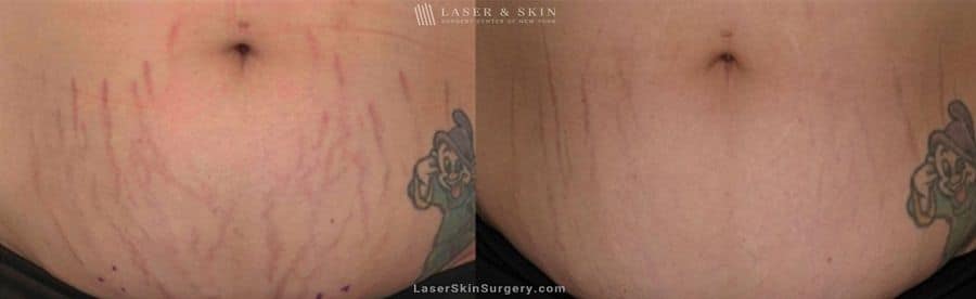 Fraxel-laser-for-stretch-marks-New-York-City-NYC stretch mark removal results