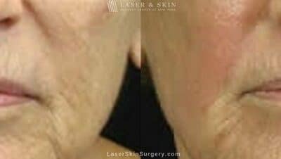 Fraxel Laser for Fine Lines and Wrinkles around the Mouth