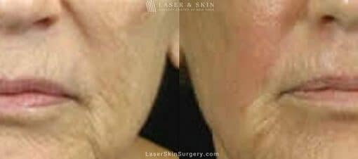 Fraxel Laser for Fine Lines and Wrinkles around the Mouth