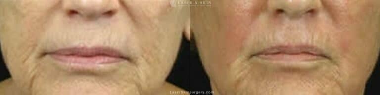 Fraxel Laser for Fine Lines and Wrinkles around the Mouth