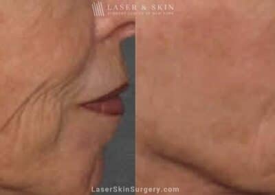 Fraxel Laser for Lines around the Mouth