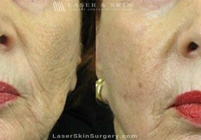 Fraxel Laser for Mouth Wrinkles