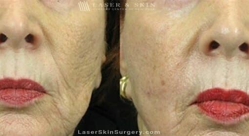 Fraxel Laser for Mouth Wrinkles