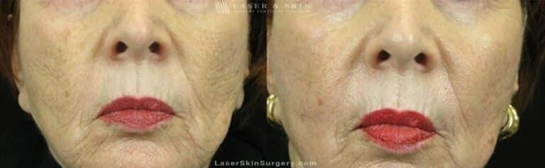 Fraxel Laser for Mouth Wrinkles