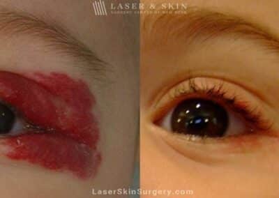 Laser treatment to remove hemangioma from around child’s eye