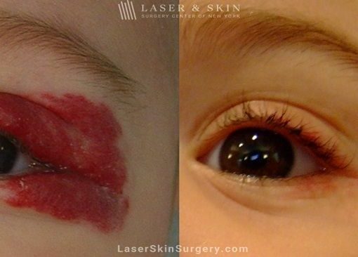 Laser treatment to remove hemangioma from around child’s eye