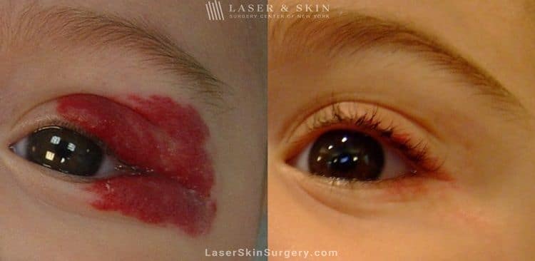 Laser treatment to remove hemangioma from around child’s eye