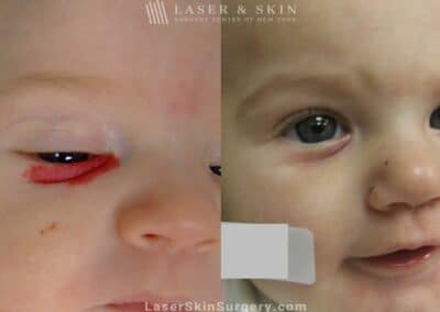 Laser used to remove hemangioma from underneath infant’s eye