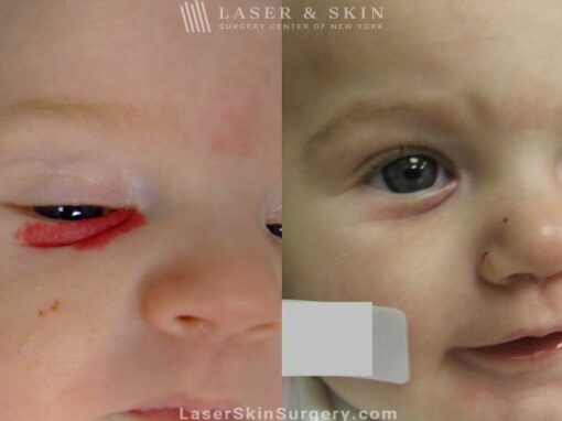 Laser used to remove hemangioma from underneath infant’s eye