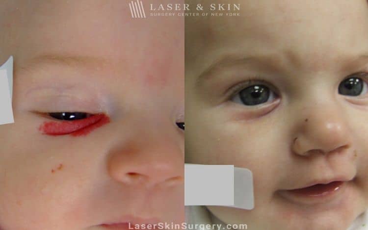 Laser used to remove hemangioma from underneath infant’s eye