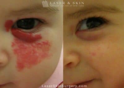 Laser to remove hemangioma from around infant’s eye