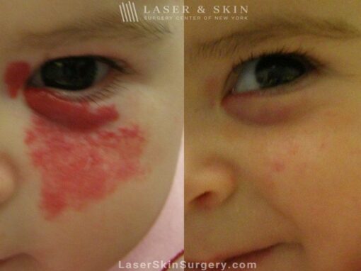 Laser to remove hemangioma from around infant’s eye