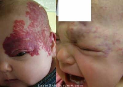 Laser Treatment for Hemangioma