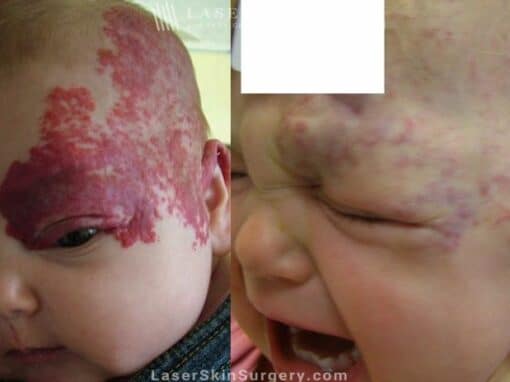 Laser Treatment for Hemangioma