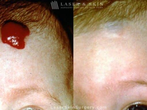 Laser Treatment for Hemangioma