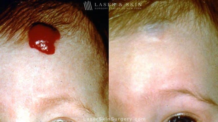 Laser Treatment for Hemangioma