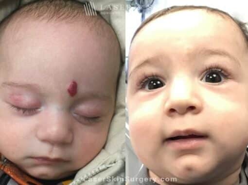 Laser Treatment for Hemangioma