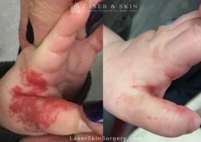 Laser used to remove hemangioma from infant’s hand