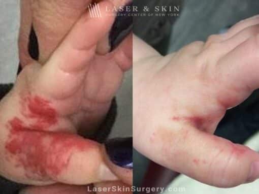 Laser used to remove hemangioma from infant’s hand