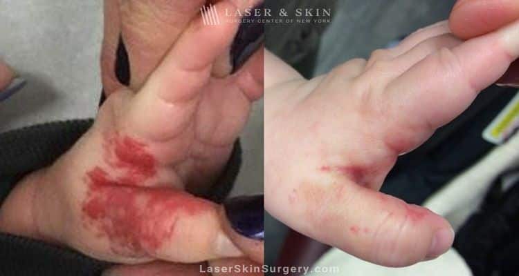 Laser used to remove hemangioma from infant’s hand