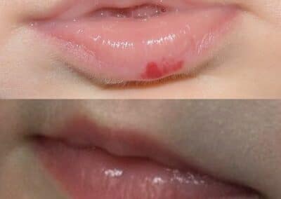 Laser Treatment for Hemangioma