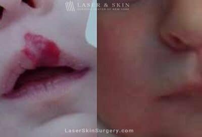 Laser Treatment for Hemangioma