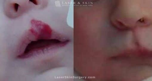 Laser Treatment for Hemangioma