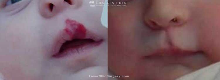 Laser Treatment for Hemangioma