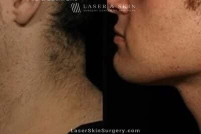 Kybella to Treat Double Chin