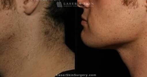 Kybella to Treat Double Chin