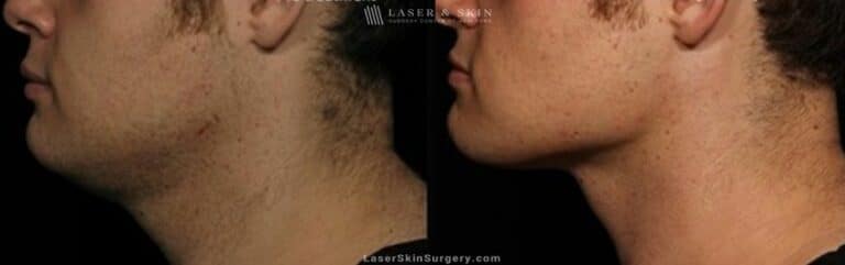 Kybella to Treat Double Chin