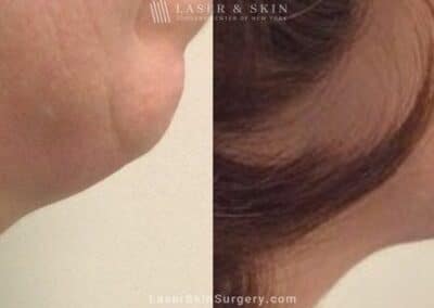 Kybella to Treat Double Chin