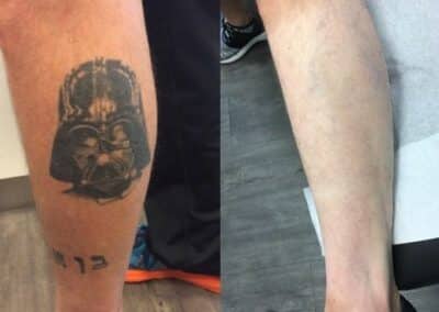 Lasers used to remove tattoo from patient’s leg