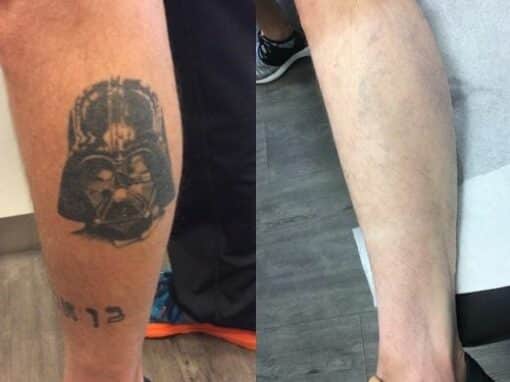 Lasers used to remove tattoo from patient’s leg