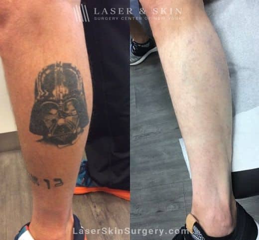 Lasers used to remove tattoo from patient’s leg