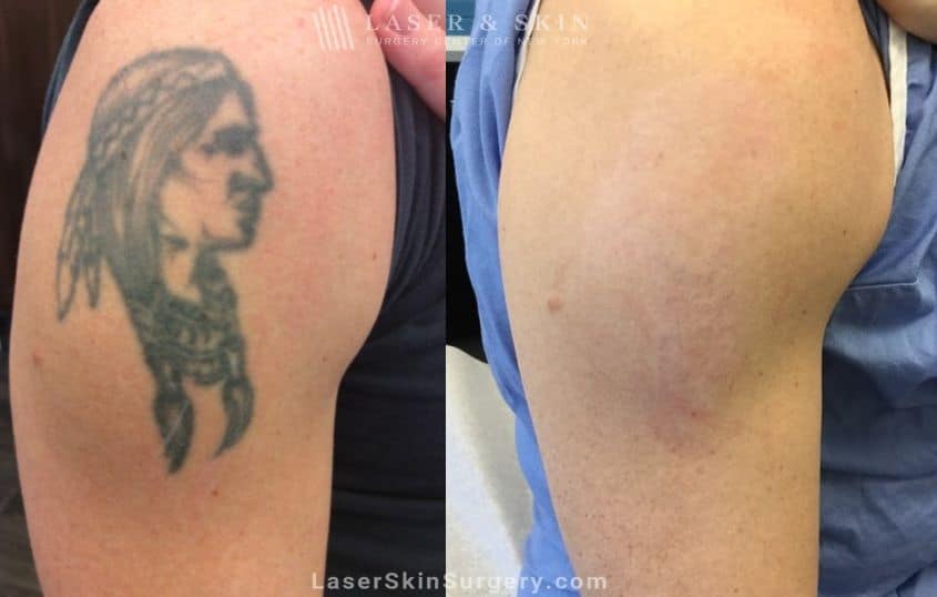 Painless Tattoo Removal Los Angeles Beverly Hills CA