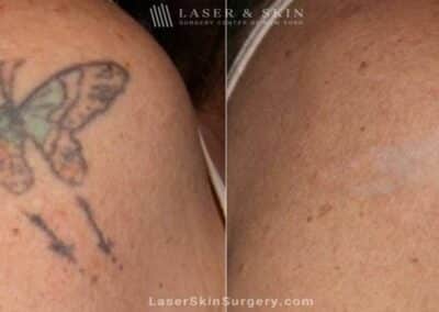 Laser Tattoo Removal